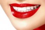 Top 63 method to whiten teeth
