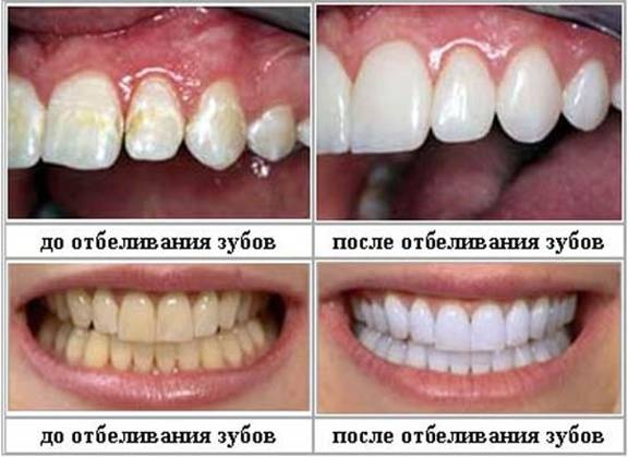 вид зубов до и после отбеливания